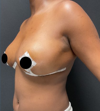 Breast Reduction Before & After Patient #3107
