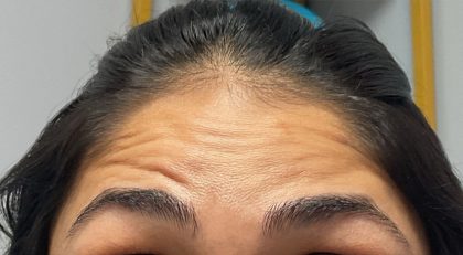 Neurotoxins Before & After Patient #3099