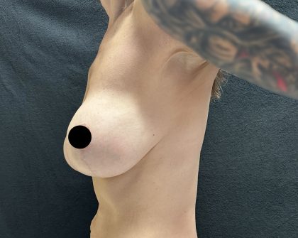 Breast Augmentation Before & After Patient #3112