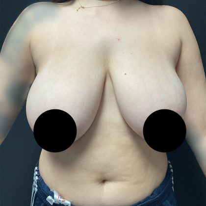 Breast Reduction Before & After Patient #3146