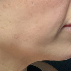 Attiva RF Before & After Patient #3143