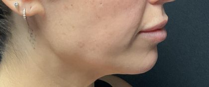 Attiva RF Before & After Patient #3143