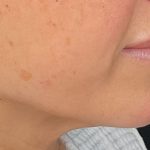 Attiva RF Before & After Patient #3143