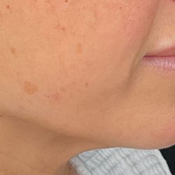 Attiva RF Before & After Patient #3143