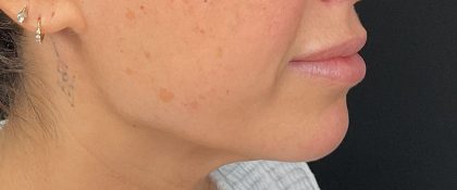 Attiva RF Before & After Patient #3143