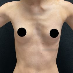 Breast Augmentation Before & After Patient #3144