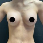 Breast Augmentation Before & After Patient #3144