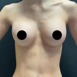 Breast Augmentation Before & After Patient #3144