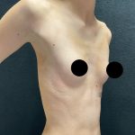 Breast Augmentation Before & After Patient #3144