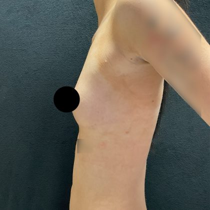 Breast Augmentation Before & After Patient #3144