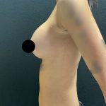 Breast Augmentation Before & After Patient #3144